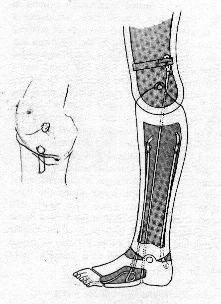 premiere-jambe-artificielle-brevetee/palmerleg-jpg.jpeg