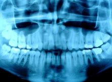 un-appareil-a-rayons-x-est-presente-en-demonstration-a-new-york/dental-x-ray2024.jpg